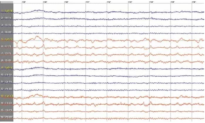 Padaczka skroniowa czy nerwica - jak odróżnić te stany?