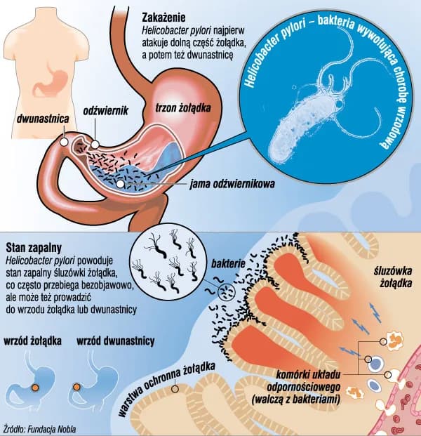Wrzody czy nerwica żołądka objawy - jak je odróżnić i leczyć?
